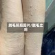 脱毛前后图片/脱毛之前