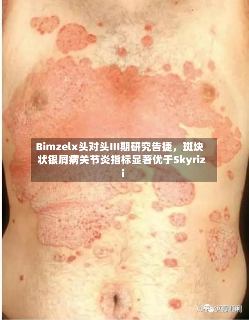 Bimzelx头对头III期研究告捷，斑块状银屑病关节炎指标显著优于Skyrizi-第2张图片