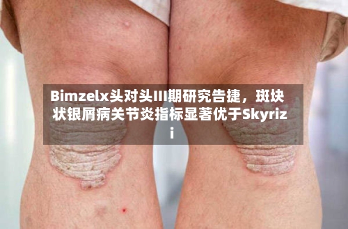 Bimzelx头对头III期研究告捷	，斑块状银屑病关节炎指标显著优于Skyrizi-第1张图片